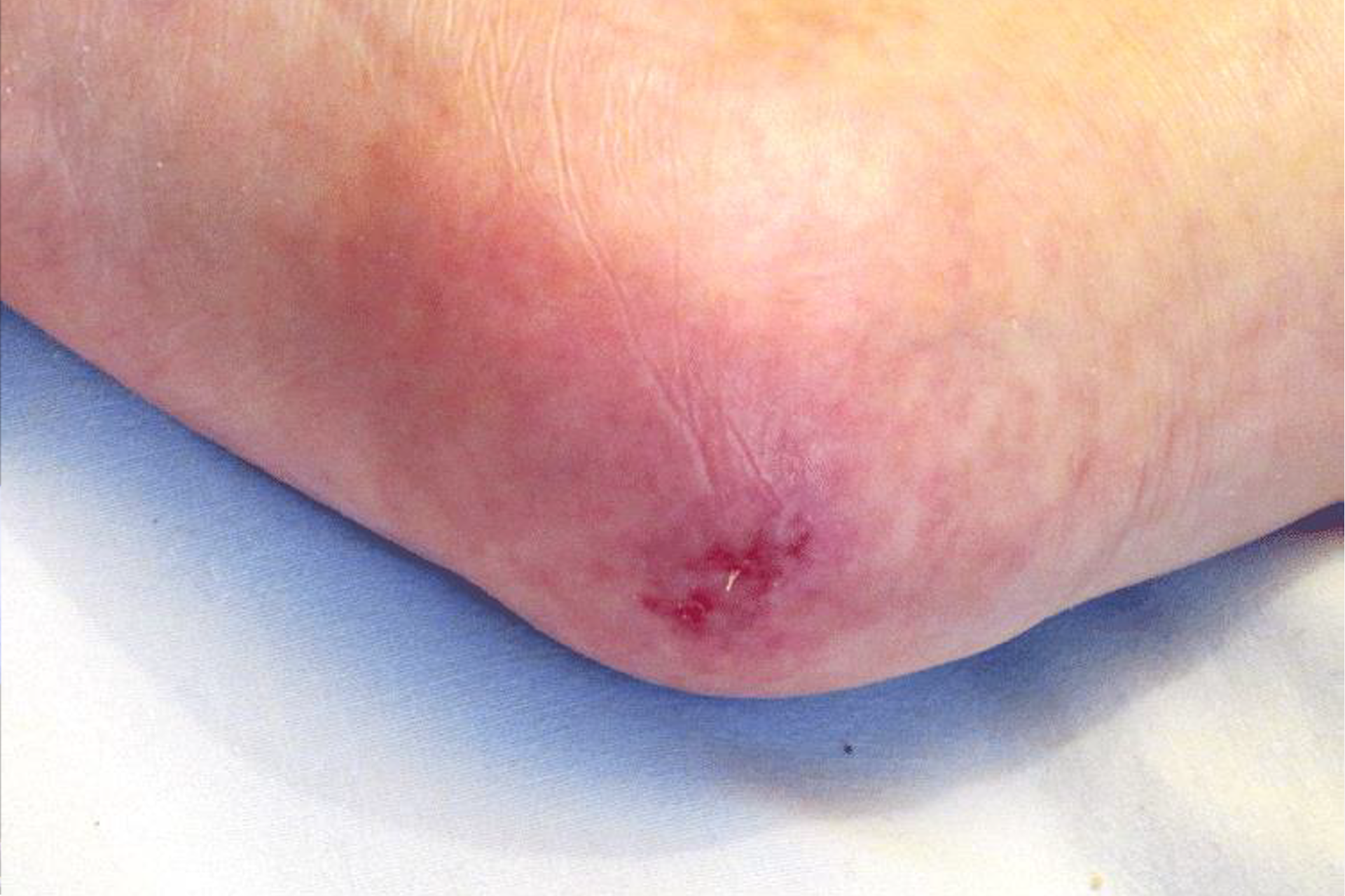 Image of a sore called a pressure ulcer on the knee